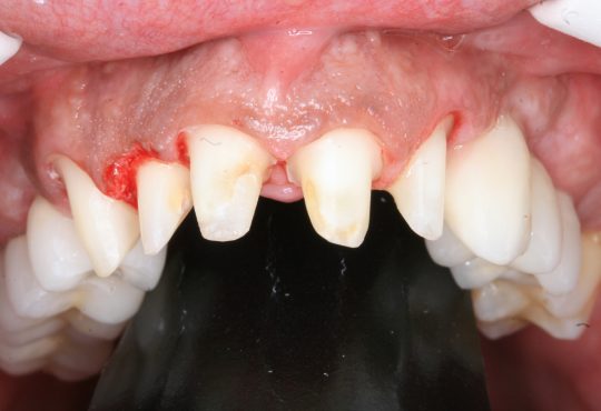 Coroas em Emax do 1.1; 1.2; 1.3 ; 2.1; 2.2