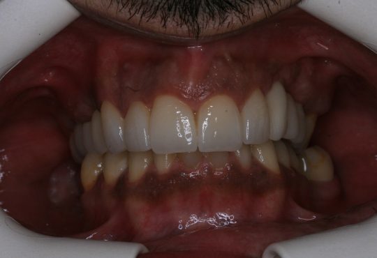 Coroas em Emax do 1.1; 1.2; 1.3 ; 2.1; 2.2