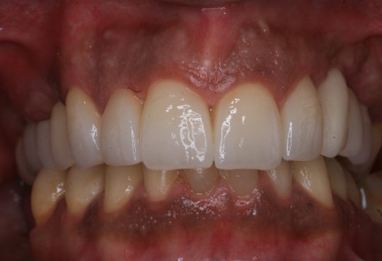 Coroas em Emax do 1.1; 1.2; 1.3 ; 2.1; 2.2