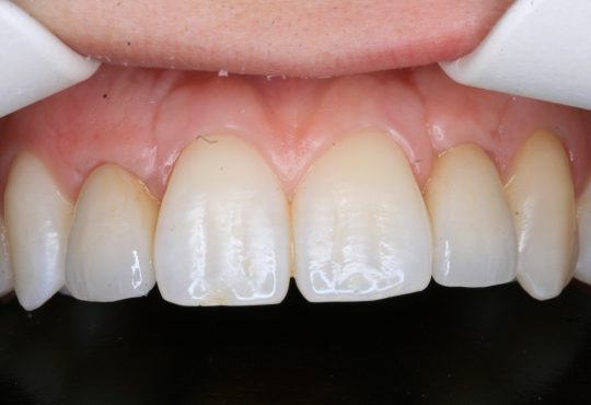 Coroas Metalo-Cerâmica sobre Implante 1.2 e 2.2